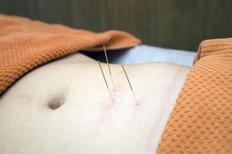 acupuntura2